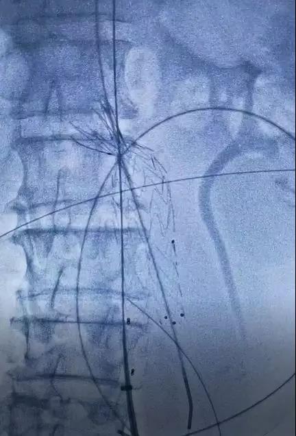 主体支架置入后造影.jpg
