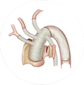 cronus™ stent graft system in surgical operation