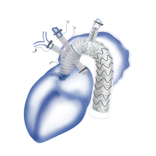 fontus™ branched stent graft system in surgical operation